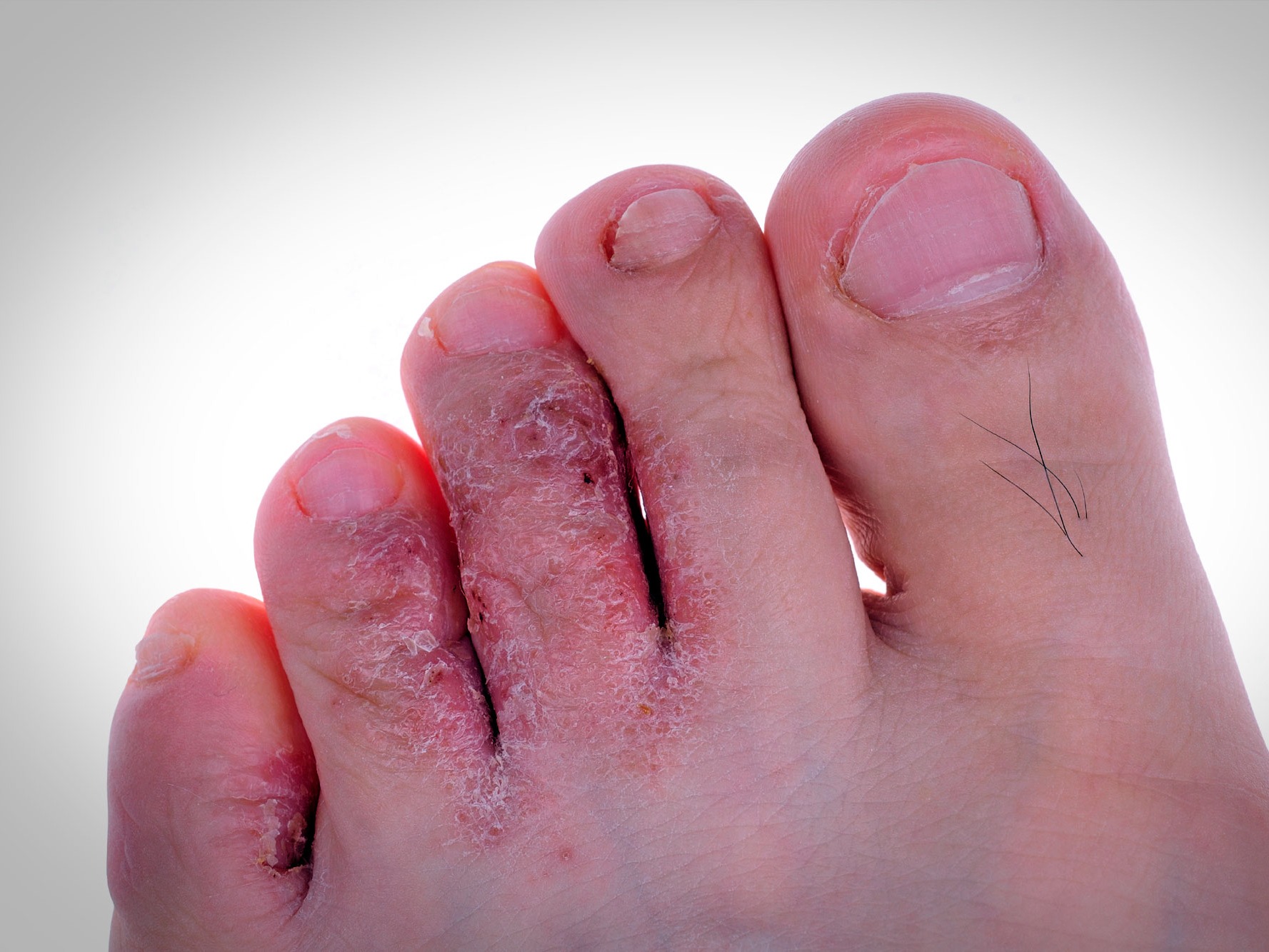 Dermatomicosis Uruapan by Slypc