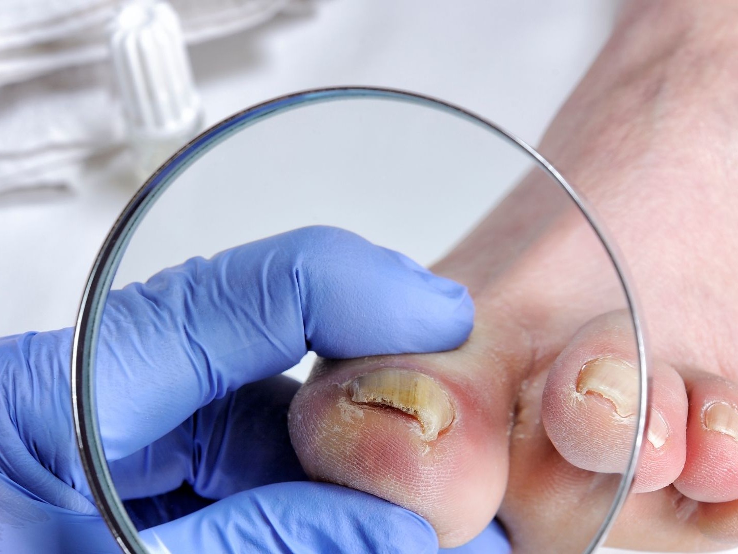 Onicomicosis Uruapan by Slypc