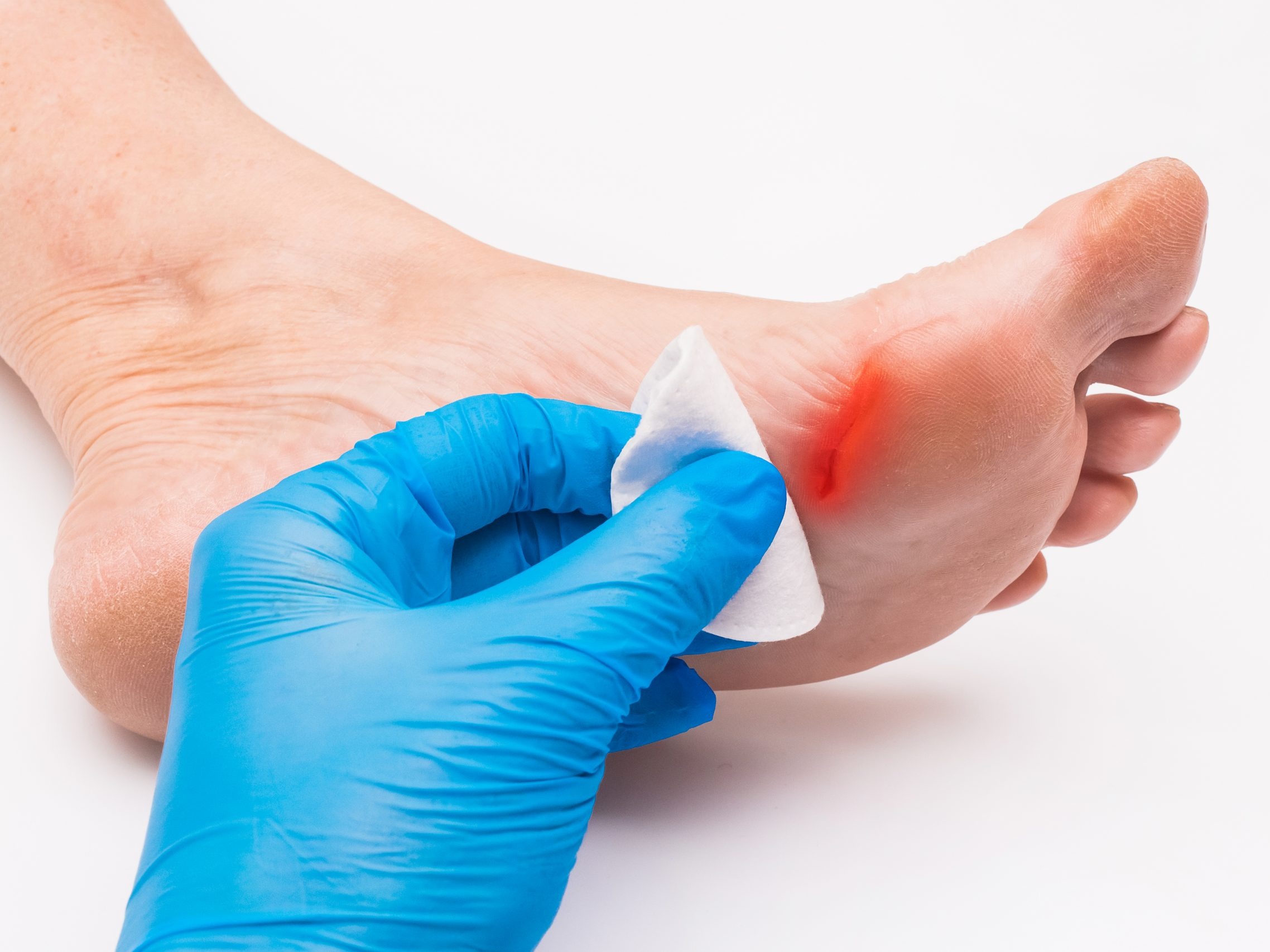 Pie diabetico Uruapan by Slypc