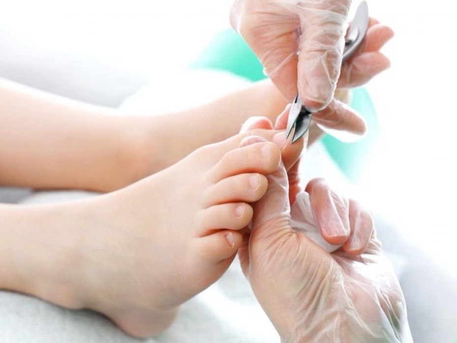 Onicocriptosis Uruapan by Slypc