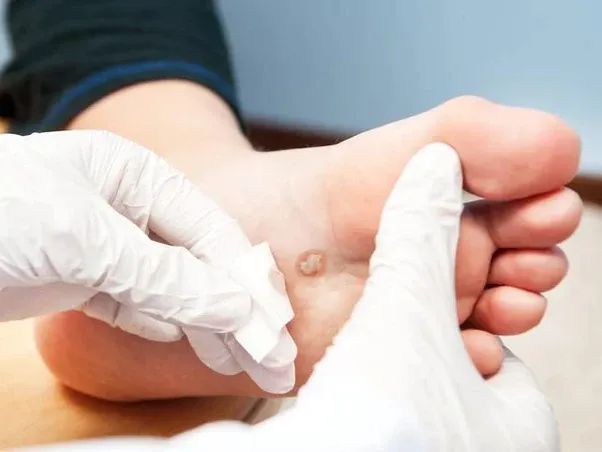 Verrugas Plantares Uruapan by Slypc